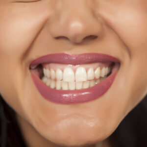 Gummy smiles can be fixed using laser gum contouring.