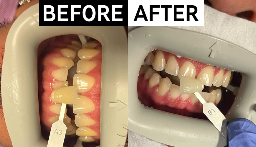 Real Norterra dental patient before and after undergoing professional teeth whitening in North Phoenix.