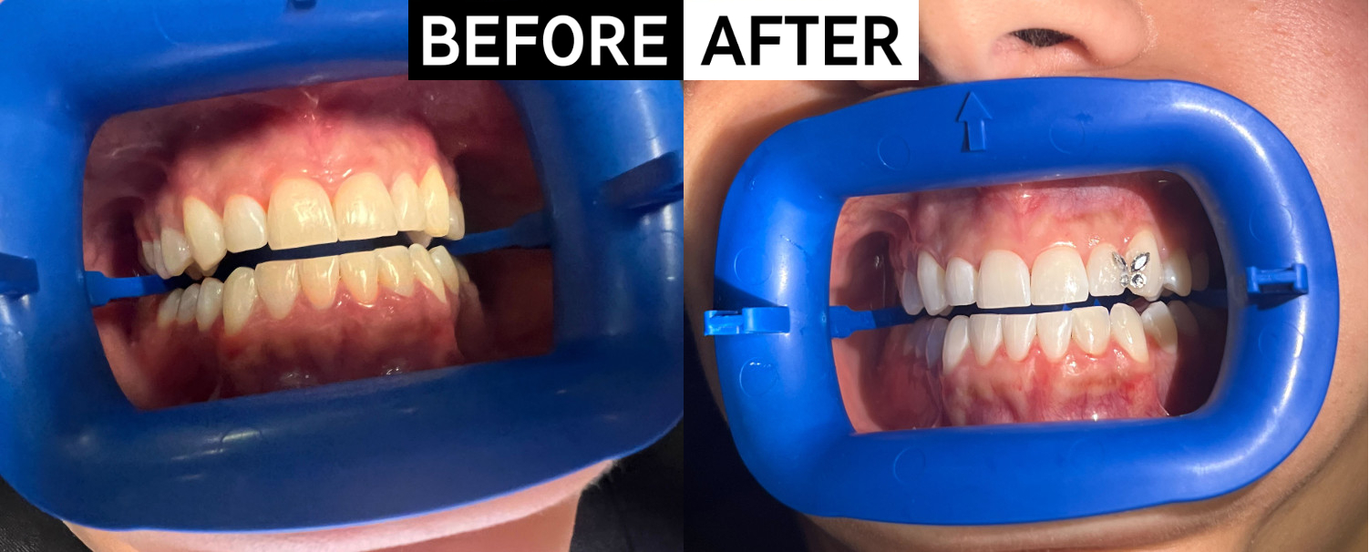 Real patient before and after receiving Zoom teeth whitening cosmetic dental treatment.