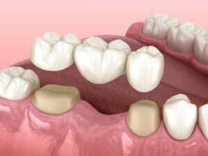 Dental bridge