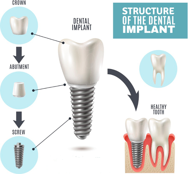 Components of a dental implant