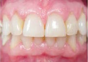 Swollen gums may indicate periodontal disease