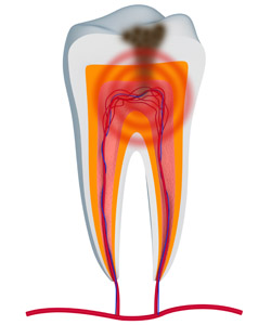 Infected tooth