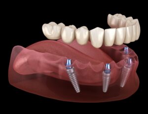 Implant-supported dentures