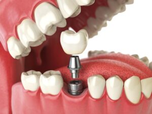 Close up photo of a tooth implant
