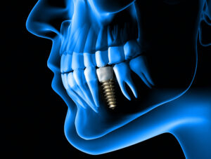 Jaw bone accepting a dental implant following bone grafting procedure.